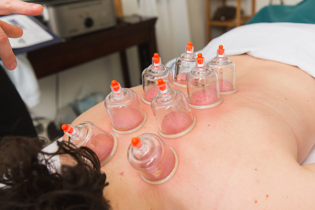 Picture of cupping therapy during a massage